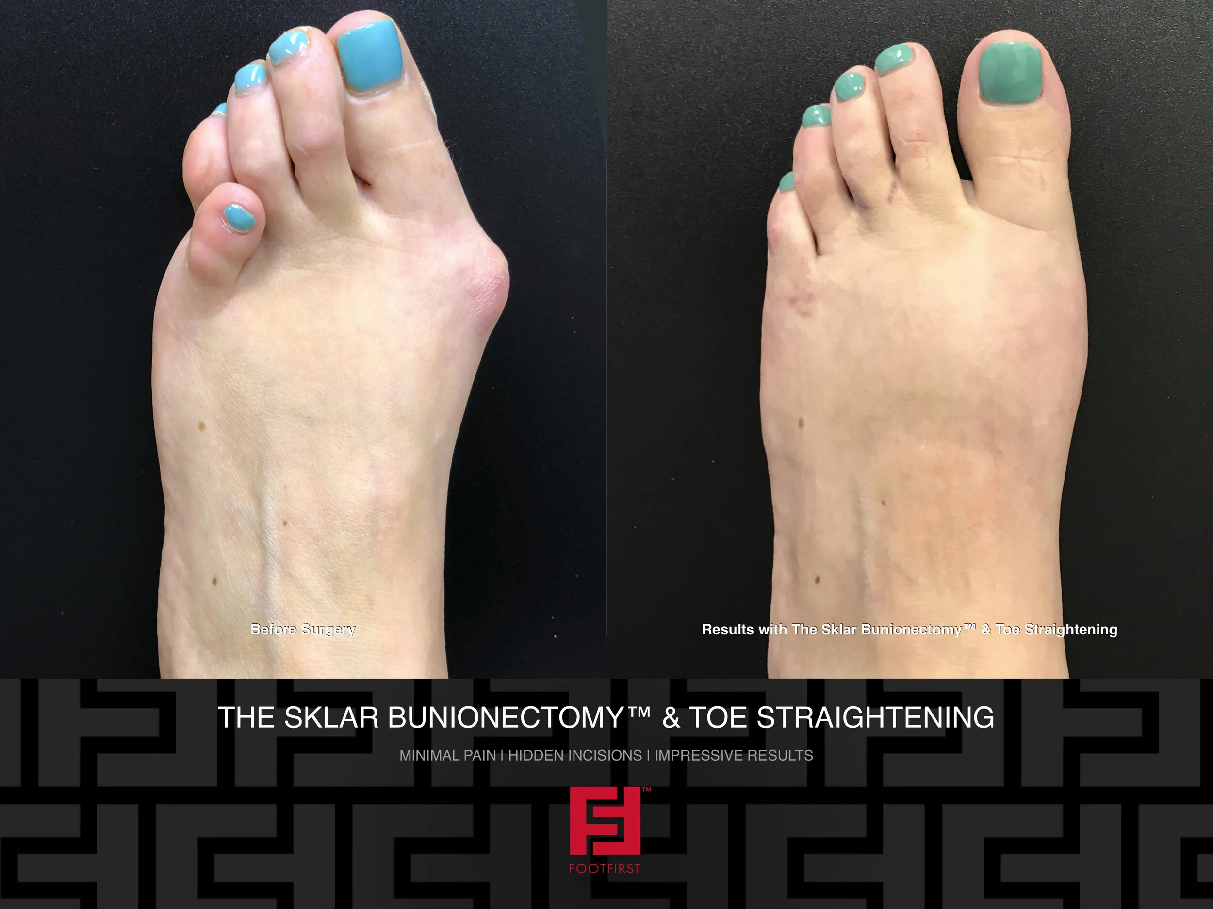 Reconstruction — Foot First Podiatry Centers